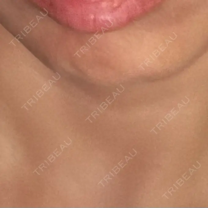 シワ取りボトックス AB美容クリニック 新宿院 AFTER メイン用