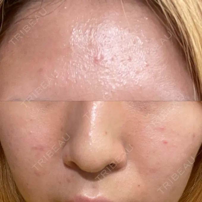 ピーリング（ニキビ・毛穴） EME CLINIC DAY 0 メイン用