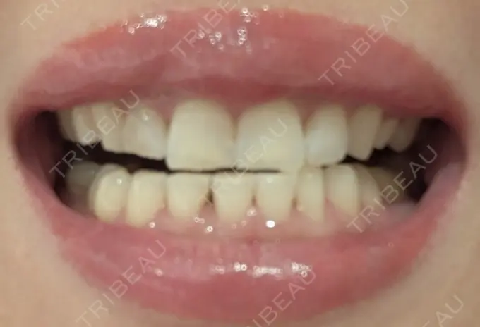 ホワイトニング SK新宿歌舞伎町美容外科・歯科 DAY 0 メイン用