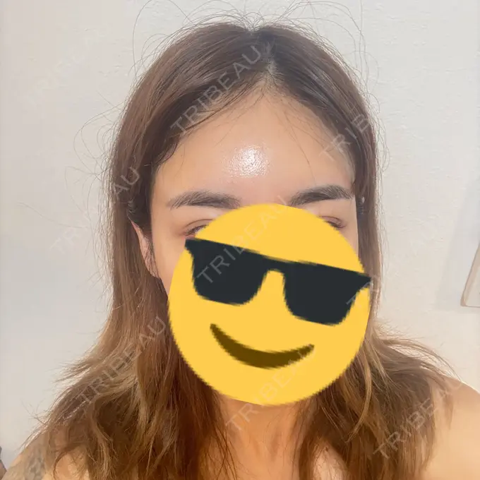 ボトックス（エラ・小顔） TCB東京中央美容外科 新宿東口院 DAY 0 メイン用