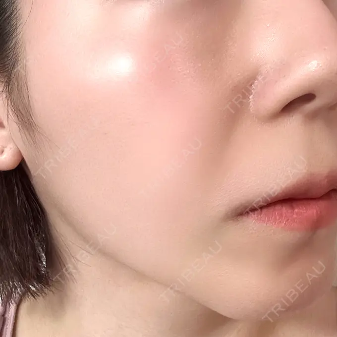 ボトックス（エラ・小顔） PRISM Beauty Clinic 町田院 DAY 60 メイン用