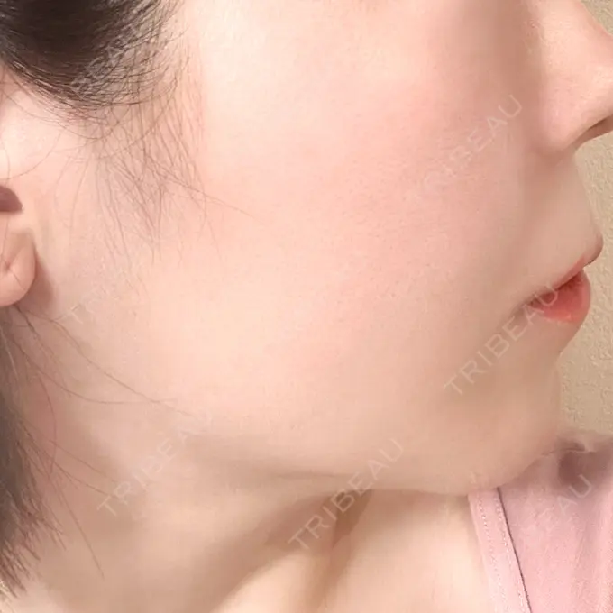 ボトックス（エラ・小顔） PRISM Beauty Clinic 町田院 DAY 60 メイン用