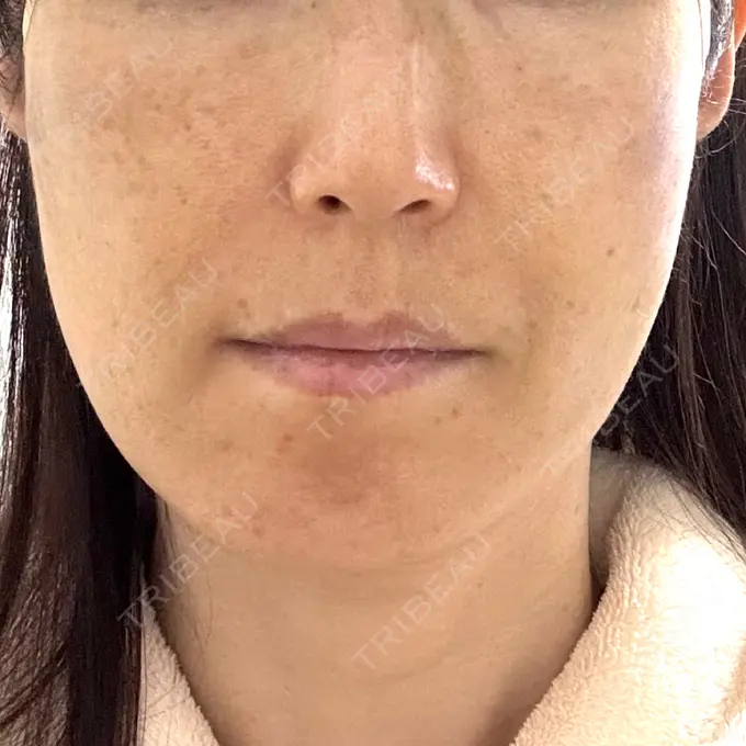 糸リフト 形成外科と美容外科のクリニック池袋 DAY 1 メイン用