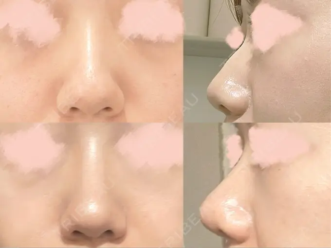 鼻尖形成（切開） / 下まぶたの脂肪取り / 真皮移植 LUHO（ルホ）美容外科 AFTER メイン用