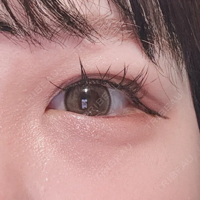 二重埋没 / ヒアルロン酸注入（涙袋） アリエル美容クリニック 横浜院 AFTER メイン用