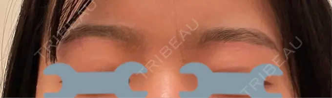 眉下切開 PRO CLINIC プロクリニック 銀座院 DAY 70 メイン用