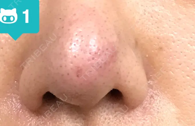 鼻尖形成（切開） 水の森美容クリニック 名古屋院 DAY 12 メイン用