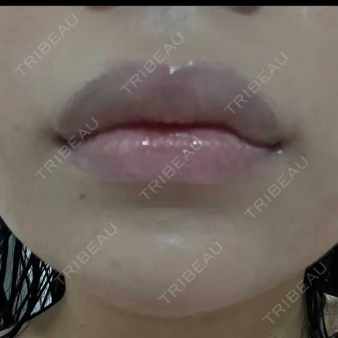 ボトックス（あご） / ヒアルロン酸注入（あご） / ボトックス（エラ・小顔） / ヒアルロン酸注入（唇） アリエル美容クリニック 横浜院 DAY 4 メイン用