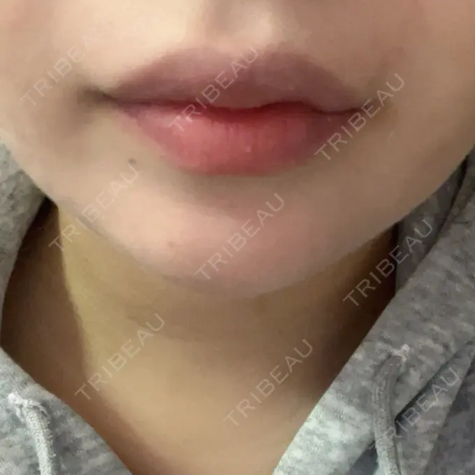 ボトックス（あご） / ヒアルロン酸注入（あご） / ボトックス（エラ・小顔） / ヒアルロン酸注入（唇） アリエル美容クリニック 横浜院 AFTER メイン用