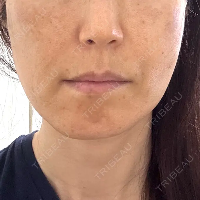 糸リフト 形成外科と美容外科のクリニック池袋 DAY 2 メイン用