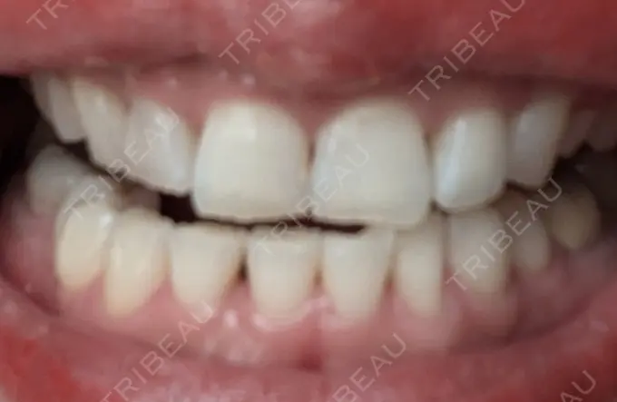 ホワイトニング SK新宿歌舞伎町美容外科・歯科 DAY 2 メイン用