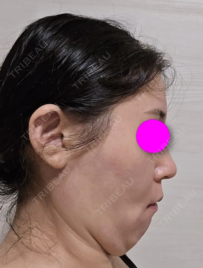 糸リフト / 脂肪吸引（二の腕） / 脂肪吸引（肩） / 脂肪吸引注射（顔） 東京シンデレラ美容外科 池袋院 DAY 0 メイン用