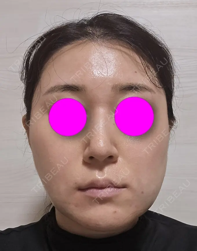 糸リフト / 脂肪吸引（二の腕） / 脂肪吸引（肩） / 脂肪吸引注射（顔） 東京シンデレラ美容外科 池袋院 DAY 0 メイン用