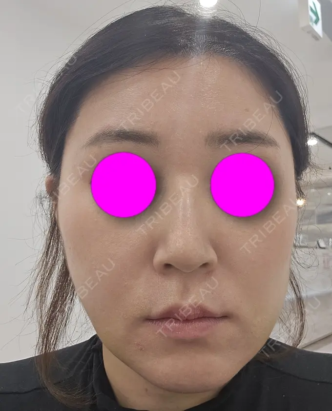 糸リフト / 脂肪吸引（二の腕） / 脂肪吸引（肩） / 脂肪吸引注射（顔） 東京シンデレラ美容外科 池袋院 AFTER メイン用