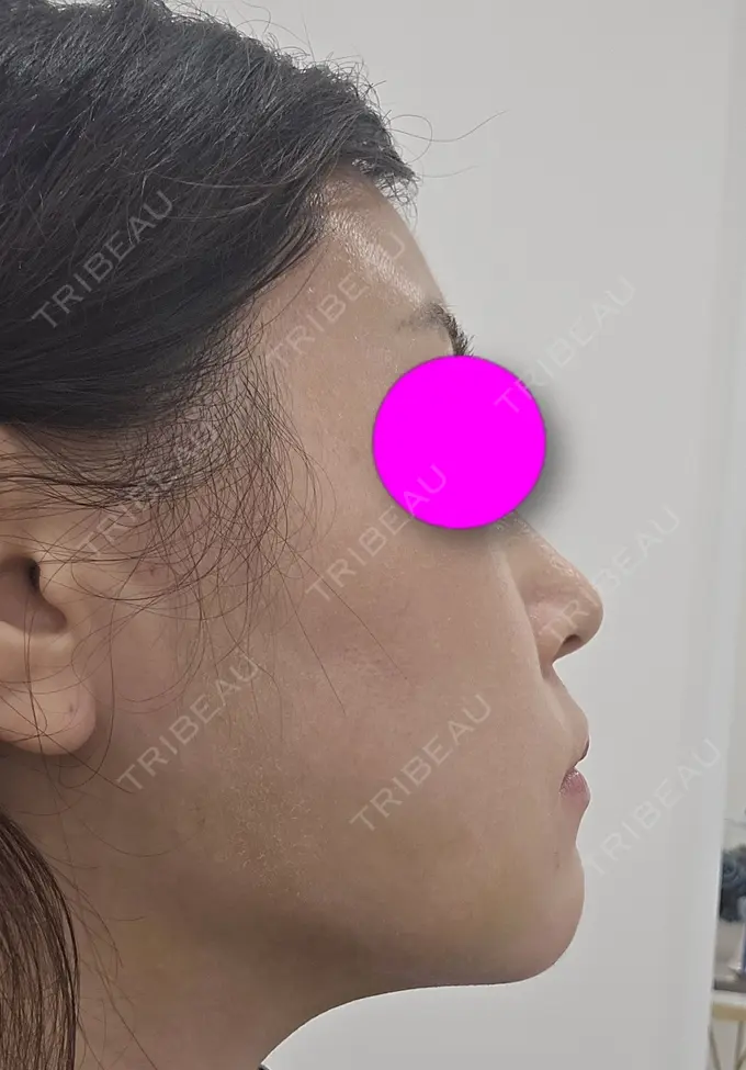 糸リフト / 脂肪吸引（二の腕） / 脂肪吸引（肩） / 脂肪吸引注射（顔） 東京シンデレラ美容外科 池袋院 DAY 7 メイン用