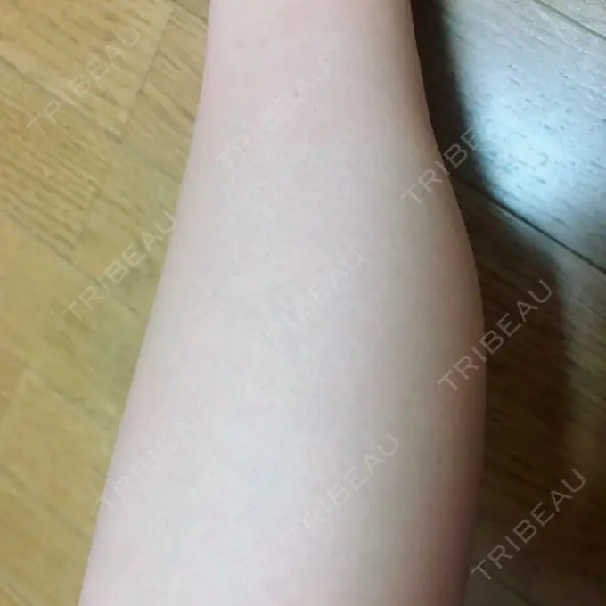 ボトックス（ふくらはぎ） REYOUNGクリニック DAY 10 メイン用