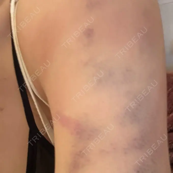 脂肪吸引（二の腕） / 脂肪吸引（お尻） / 脂肪溶解注射（太もも） WOM CLINIC GINZA （ワム クリニック ギンザ） DAY 2 メイン用