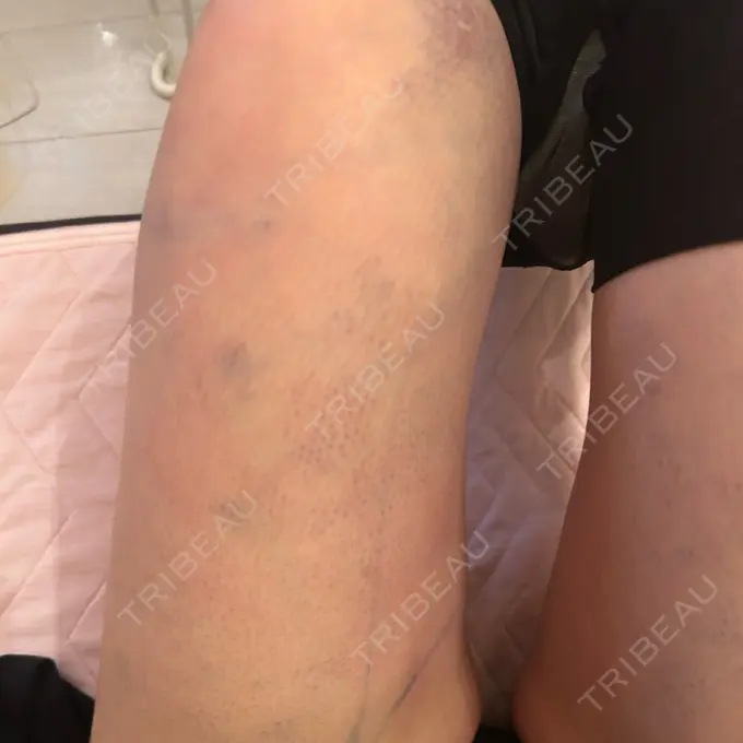 脂肪吸引（二の腕） / 脂肪吸引（お尻） / 脂肪溶解注射（太もも） WOM CLINIC GINZA （ワム クリニック ギンザ） DAY 2 メイン用