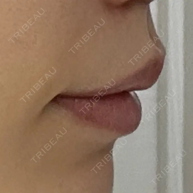 人中短縮 eクリニック 大阪梅田 西日本統括院 DAY 71 メイン用