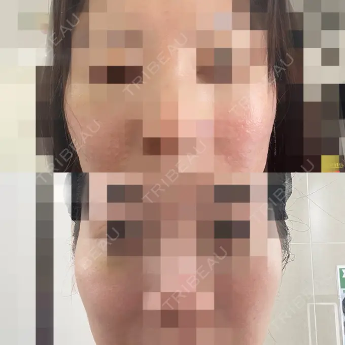 脂肪溶解注射 / 脂肪溶解注射（お腹） / 肌育注射（ジュベルックなど） / 美肌レーザー / RF（高周波）たるみ治療 AB美容クリニック 新宿院 AFTER メイン用