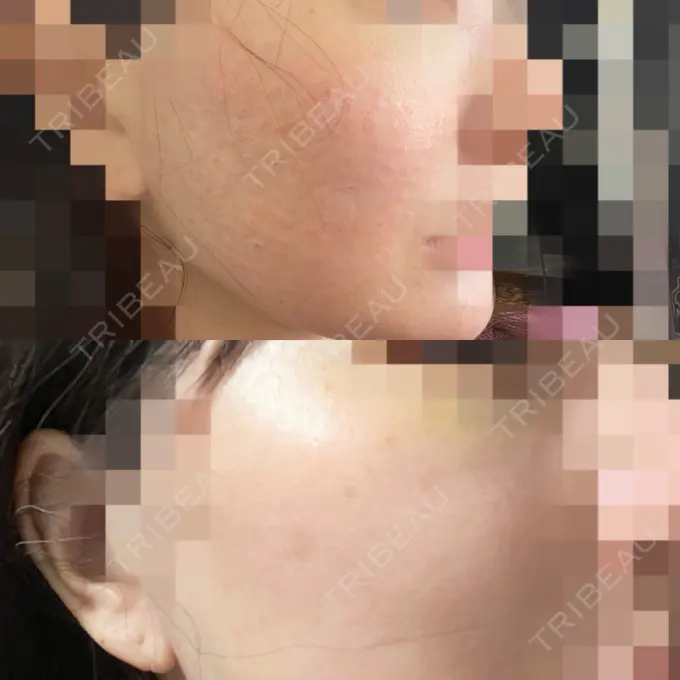 脂肪溶解注射 / 脂肪溶解注射（お腹） / 肌育注射（ジュベルックなど） / 美肌レーザー / RF（高周波）たるみ治療 AB美容クリニック 新宿院 DAY 0 メイン用