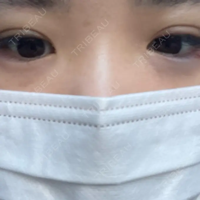 ヒアルロン酸注入（涙袋） アネシス美容クリニック DAY 0 メイン用