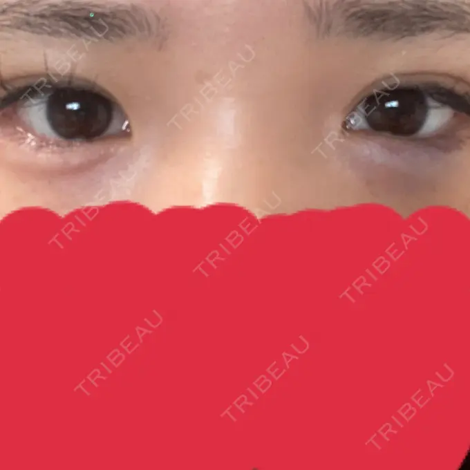 ヒアルロン酸注入（涙袋） アネシス美容クリニック DAY 0 メイン用