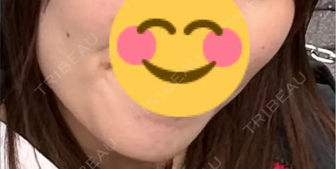 ボトックス（エラ・小顔） ルラ美容クリニック 千葉院 / ルラスキンクリニック 千葉院 AFTER メイン用