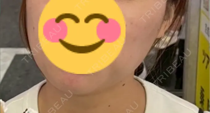 ボトックス（エラ・小顔） ルラ美容クリニック 千葉院 / ルラスキンクリニック 千葉院 DAY 0 メイン用