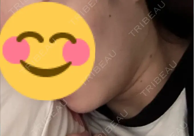 ボトックス（エラ・小顔） ルラ美容クリニック 千葉院 / ルラスキンクリニック 千葉院 DAY 0 メイン用