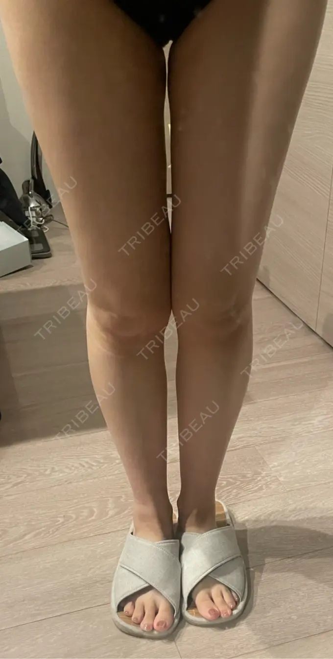 脂肪吸引（顔） / 脂肪吸引（二の腕） / 脂肪吸引（脚） / 脂肪吸引（お腹） / 脂肪吸引（お尻） / 豊胸（脂肪注入） / 脂肪吸引（腰） / 脂肪吸引（背中） / 脂肪吸引（肩） ヴェルトラクリニック 新宿院 DAY 11 メイン用