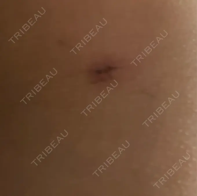 脂肪吸引（顔） / 脂肪吸引（二の腕） / 脂肪吸引（脚） / 脂肪吸引（お腹） / 脂肪吸引（お尻） / 豊胸（脂肪注入） / 脂肪吸引（腰） / 脂肪吸引（背中） / 脂肪吸引（肩） ヴェルトラクリニック 新宿院 DAY 11 メイン用