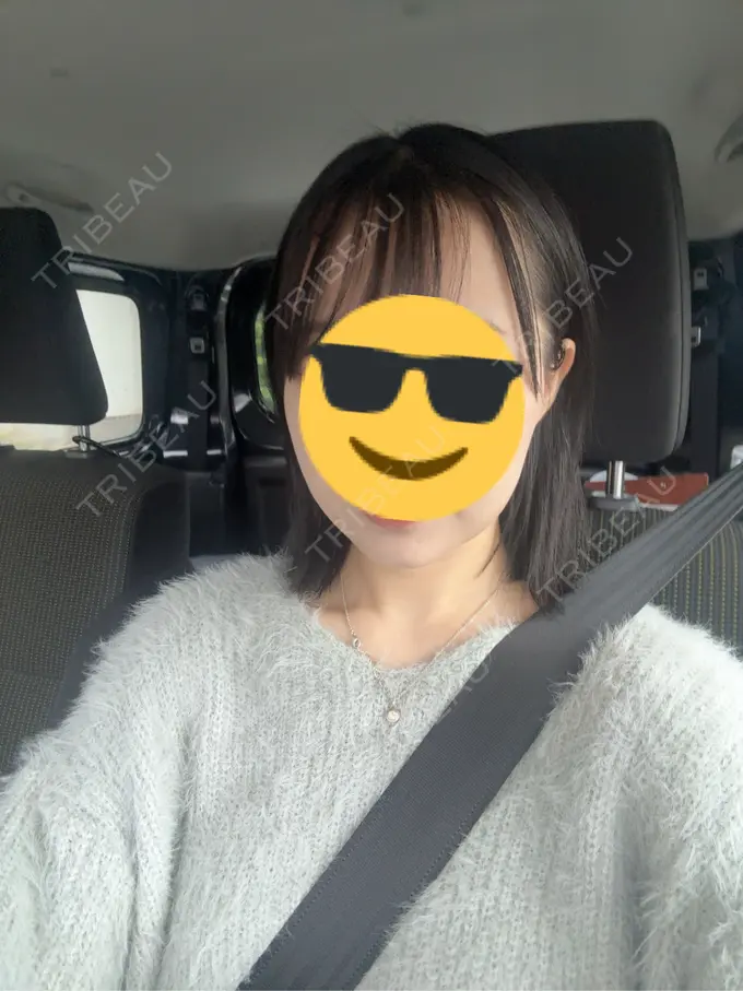 ボトックス（エラ・小顔） TCB東京中央美容外科 浜松院 DAY 20 メイン用