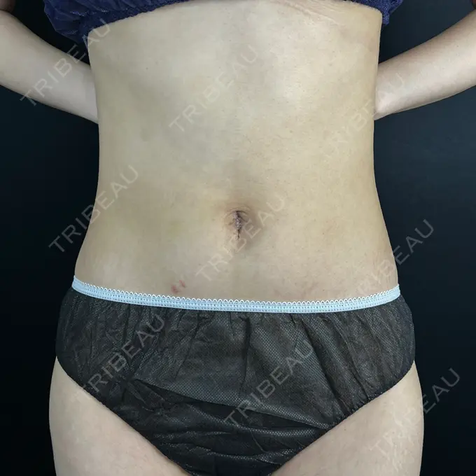 へそ形成 藤・ナチュレ美容クリニック 銀座院 DAY 11 メイン用