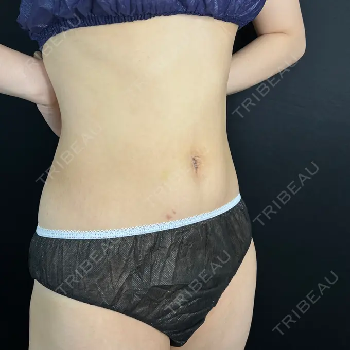 へそ形成 藤・ナチュレ美容クリニック 銀座院 DAY 11 メイン用