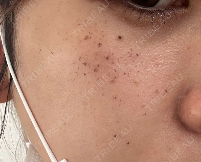 その他（肌） / イオン導入 / ルメッカ ルラ美容クリニック 広島院 DAY 1 メイン用