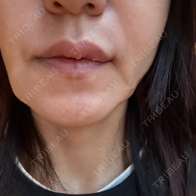 ヒアルロン酸注入（唇） 新未来クリニック AFTER メイン用