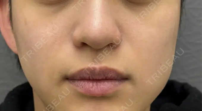 小鼻縮小（切開） 渋谷の森クリニック AFTER メイン用