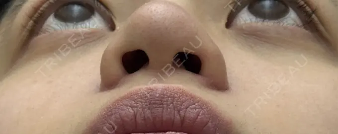 小鼻縮小（切開） 渋谷の森クリニック DAY 84 メイン用