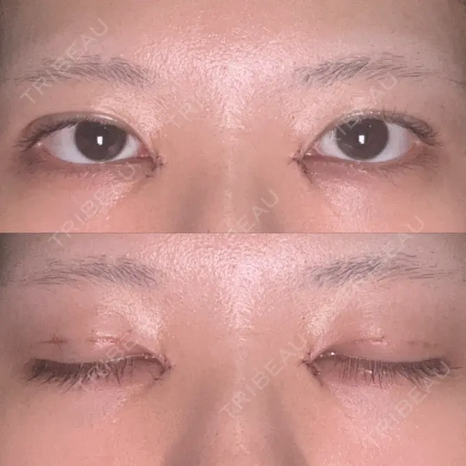 二重埋没 / 目頭切開 くさのたろうクリニック DAY 0 メイン用