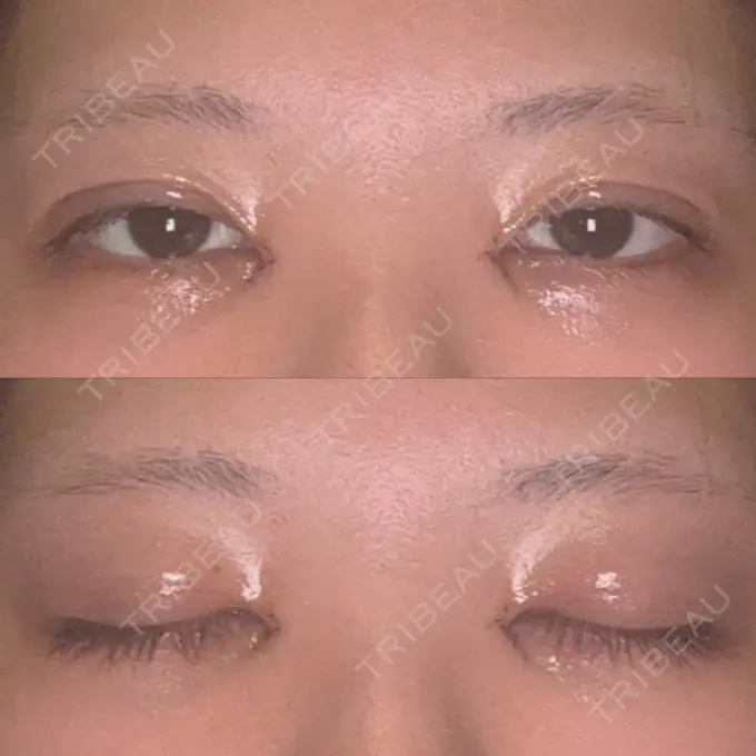 二重埋没 / 目頭切開 くさのたろうクリニック DAY 2 メイン用