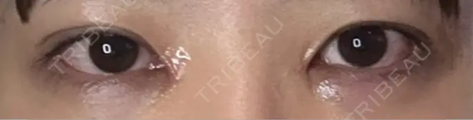 二重埋没 / 目頭切開 くさのたろうクリニック DAY 16 メイン用