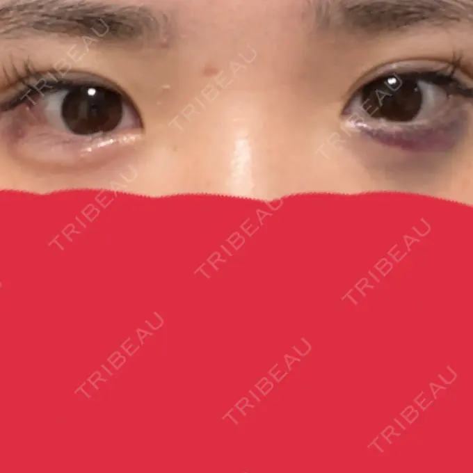 ヒアルロン酸注入（涙袋） アネシス美容クリニック DAY 1 メイン用