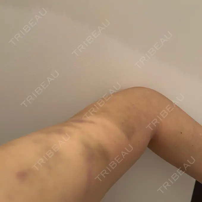 脂肪吸引（二の腕） / 脂肪吸引（お尻） / 脂肪溶解注射（太もも） WOM CLINIC GINZA （ワム クリニック ギンザ） DAY 4 メイン用