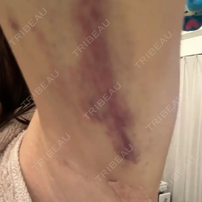 脂肪吸引（二の腕） / 脂肪吸引（お尻） / 脂肪溶解注射（太もも） WOM CLINIC GINZA （ワム クリニック ギンザ） DAY 4 メイン用