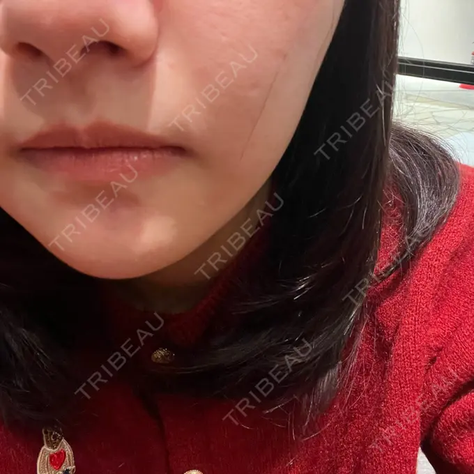 毛穴洗浄（ハイドラフェイシャルなど） 心斎橋KT美容クリニック DAY 0 メイン用