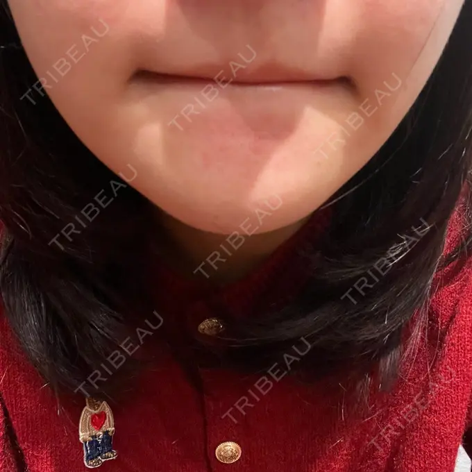 毛穴洗浄（ハイドラフェイシャルなど） 心斎橋KT美容クリニック DAY 0 メイン用