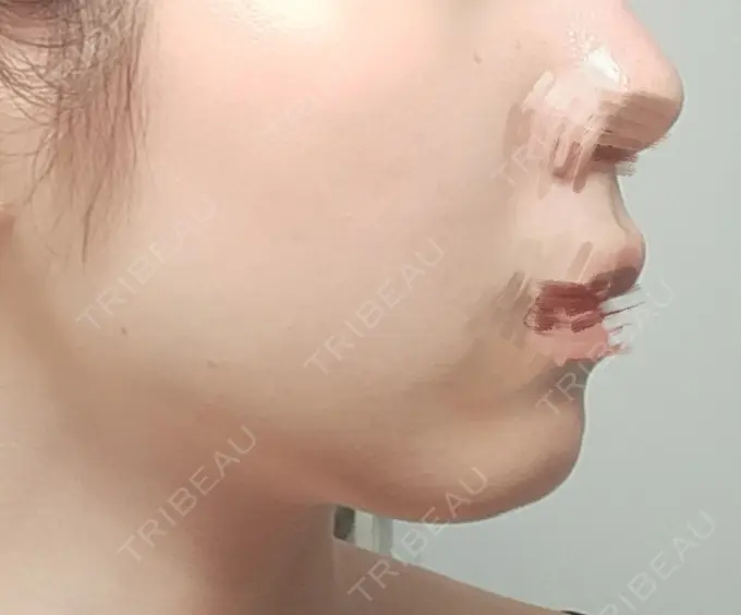 その他（輪郭） BITO BEAUTY CLINIC DAY 42 メイン用