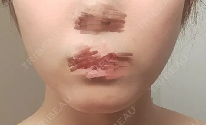 その他（輪郭） BITO BEAUTY CLINIC AFTER メイン用