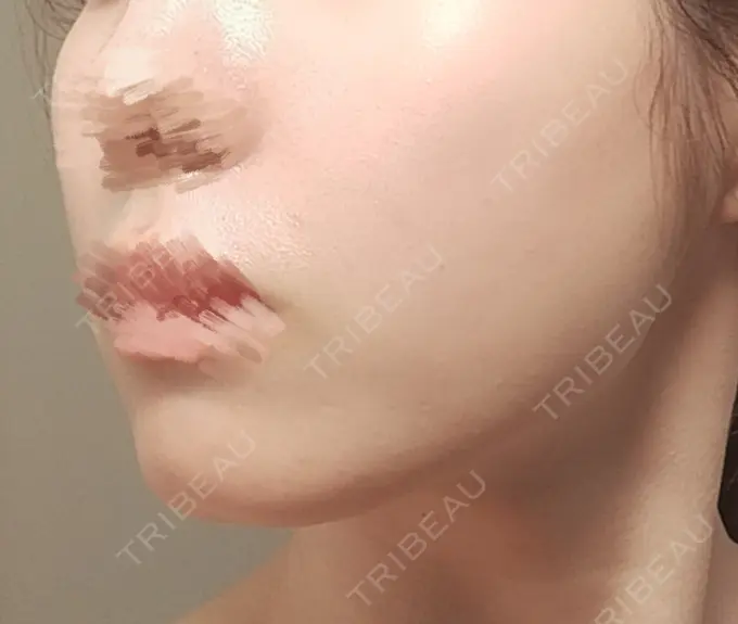 その他（輪郭） BITO BEAUTY CLINIC DAY 42 メイン用